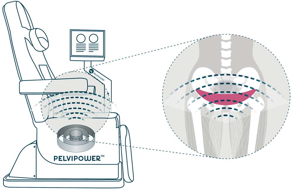 PelviPower™ magnetoterápiás kezelés